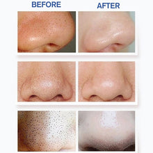 Load image into Gallery viewer, Blackhead Remover Vaccum Suction Facial Cleaner - goget-glow.com