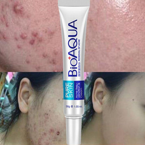 Acne Treatment Blackhead Remove Anti Acne Cream - goget-glow.com